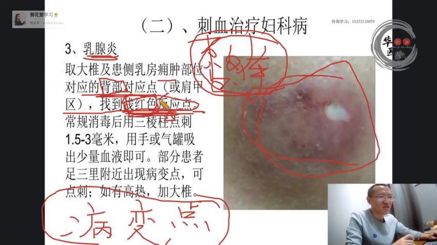 高晓尚 非物质文化遗产-循经刺络疗法精品课 网盘分享(734.35M)